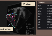 Is your Heart Sound and Sounding Fine? VPT